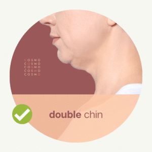 double chin