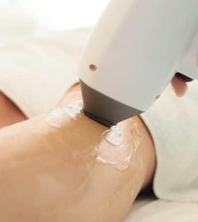 What to Expect During a Laser Hair Removal Treatment